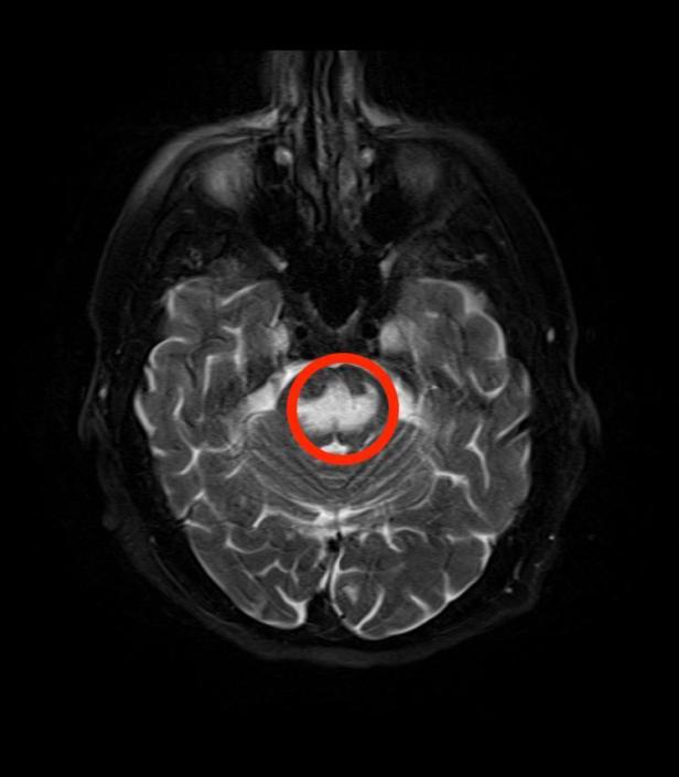 MRI_Central_Pontine_Myelinolysis_fat_sat_T2.jpg