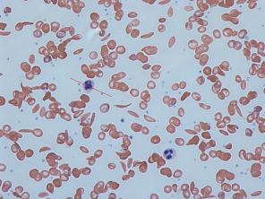 Sickle_cells