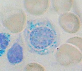 Ringed Sideroblast
