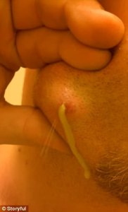 http://www.dailymail.co.uk/health/article-4841886/Man-pops-abscess-cheek.html